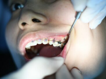 person with silver teeth braces