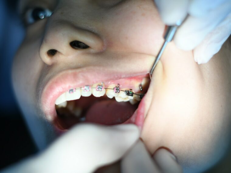 person with silver teeth braces